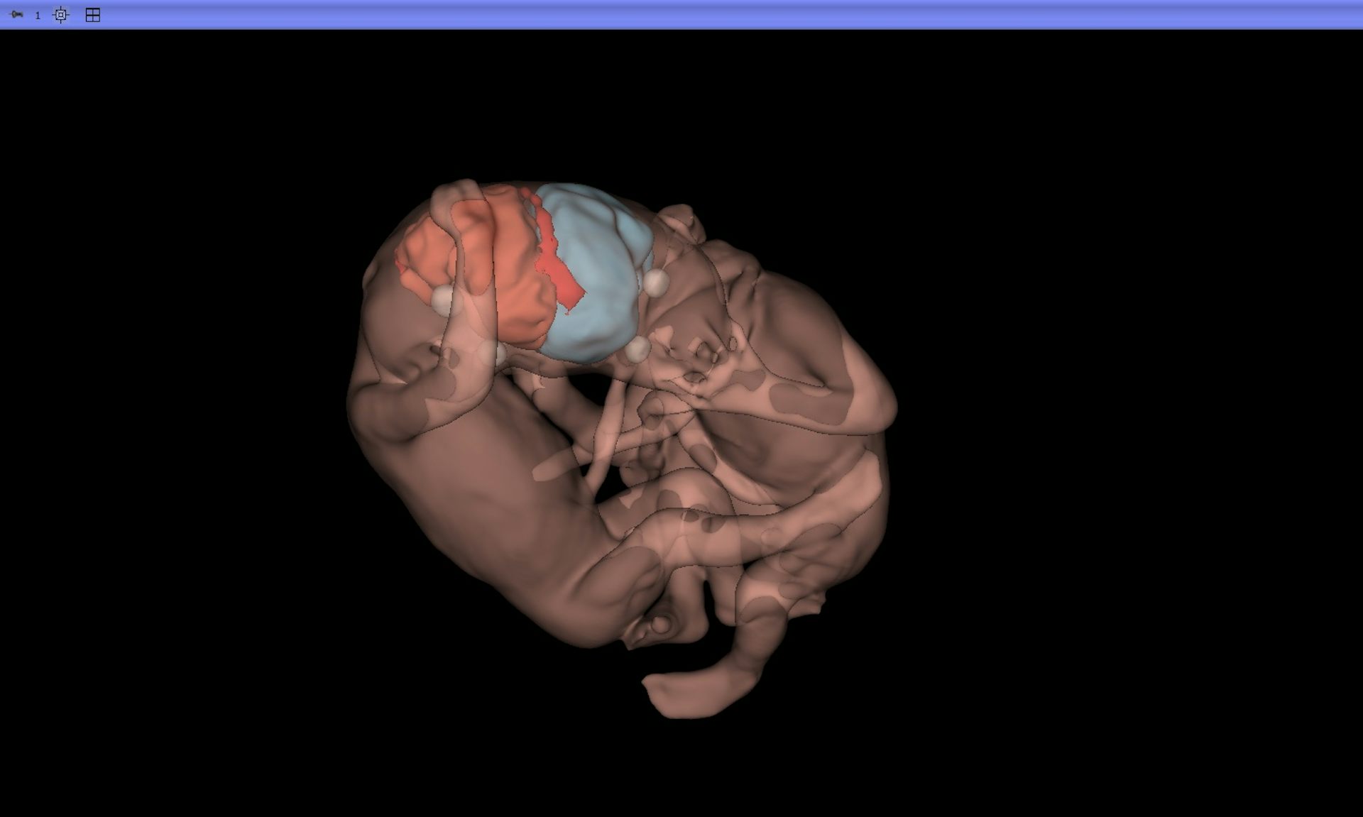 Imagens que salvam: IA e ultrassom 3D revolucionam medicina fetal e são decisivas para gêmeos siameses