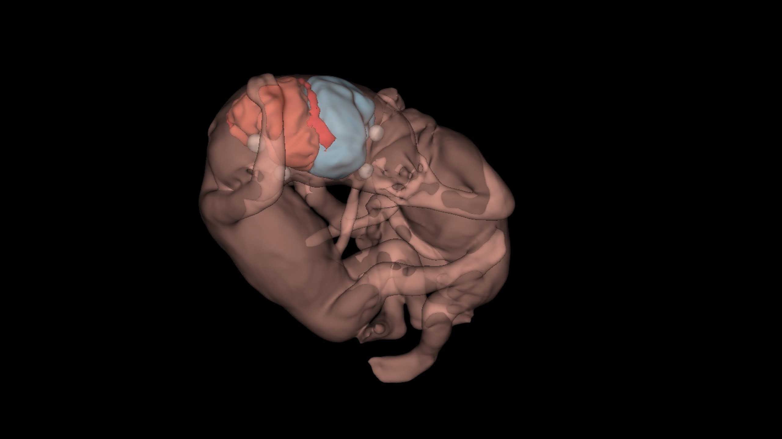Imagens que salvam: IA e ultrassom 3D revolucionam medicina fetal e são decisivas para gêmeos siameses