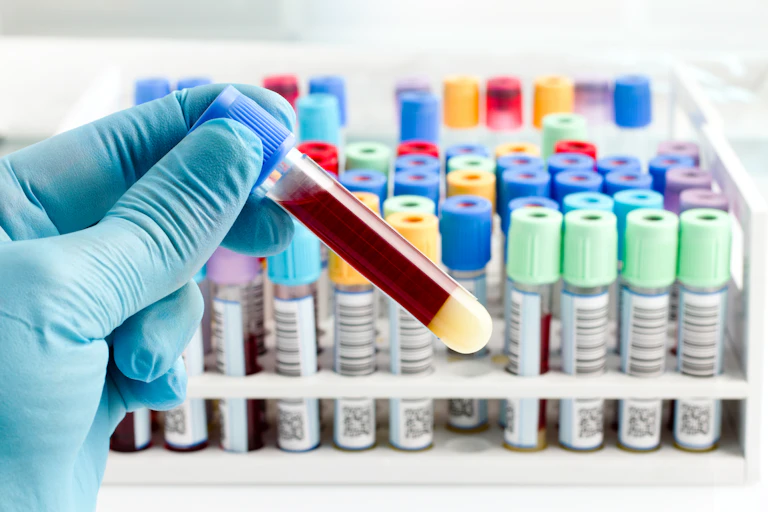 hand of a lab technician holding blood tube test and background a rack of color tubes with blood samples other patients