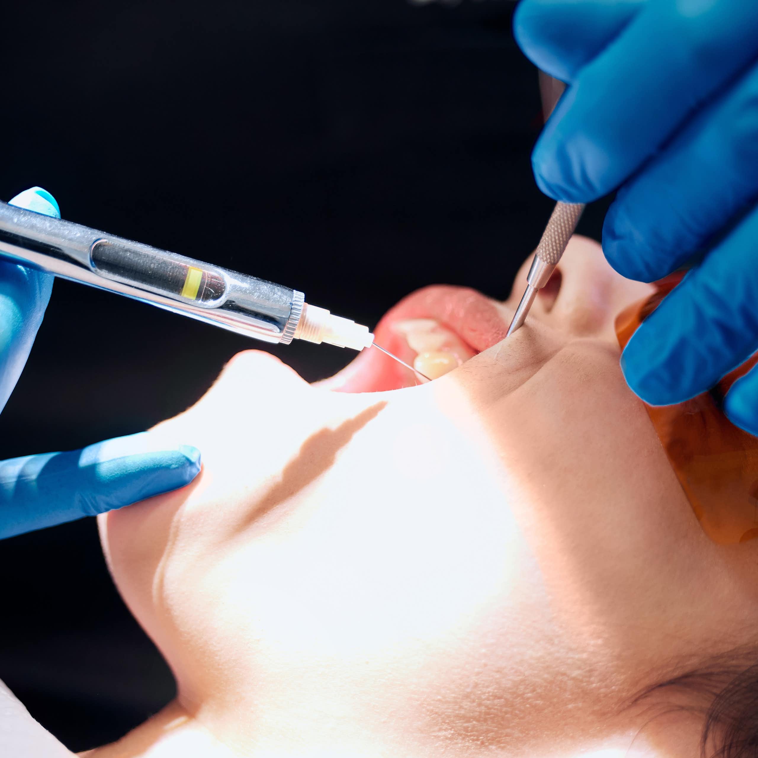 Asministración de anestesia con una jeringuilla a una mujer con la boca abierta.