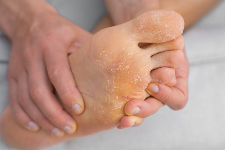 A person with Athlete's foot holds their foot in their hands.