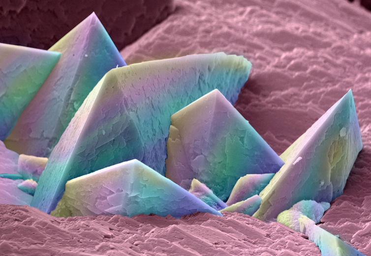 Kidney stone crystals