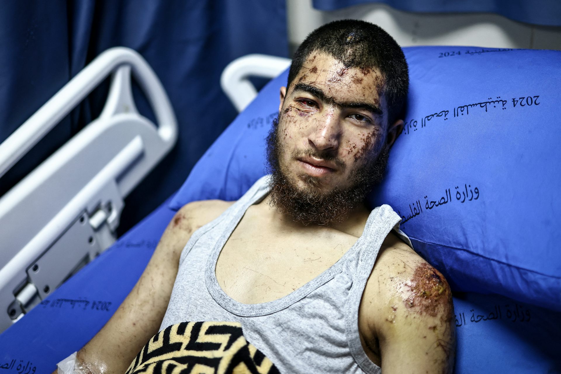 A man with visible scars and bruising lies on a bed.