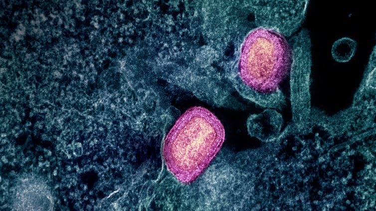 micrographie électronique à transmission du virus mpox (visible en rose, en fausses couleurs)