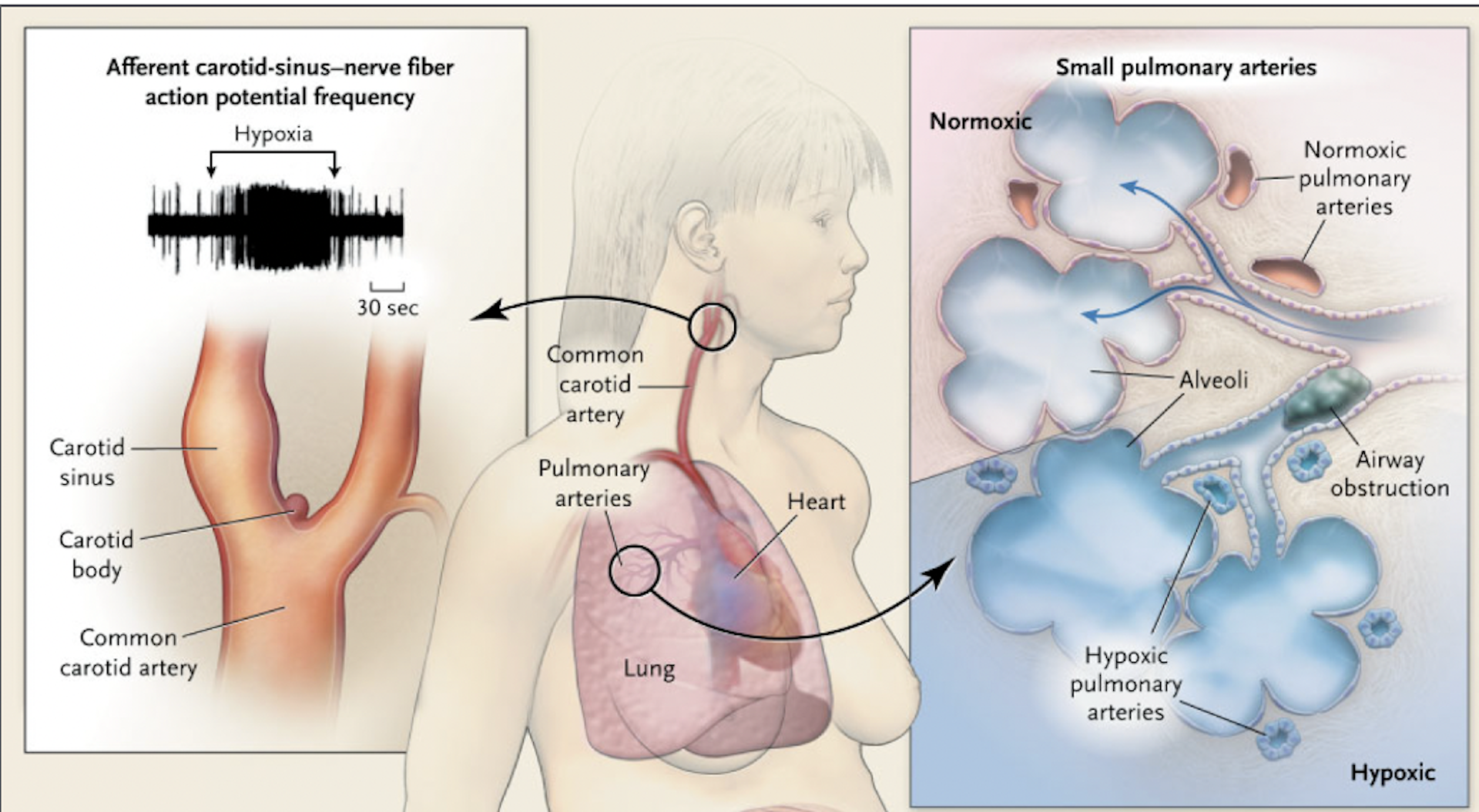 Ilustraciones que muestran el cuerpo carotídeo y los efectos de la hipoxia.