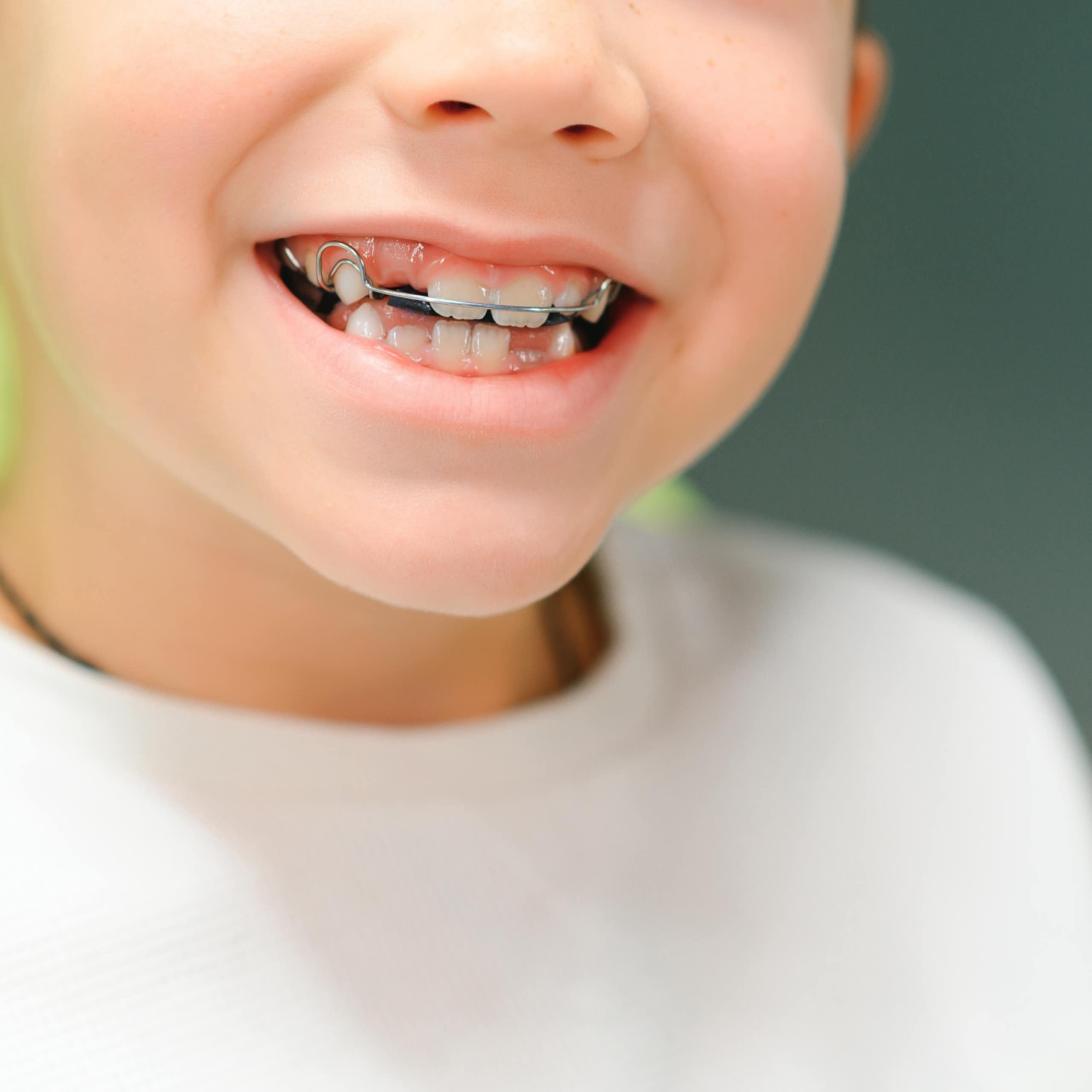 Un enfant avec un appareil dentaire