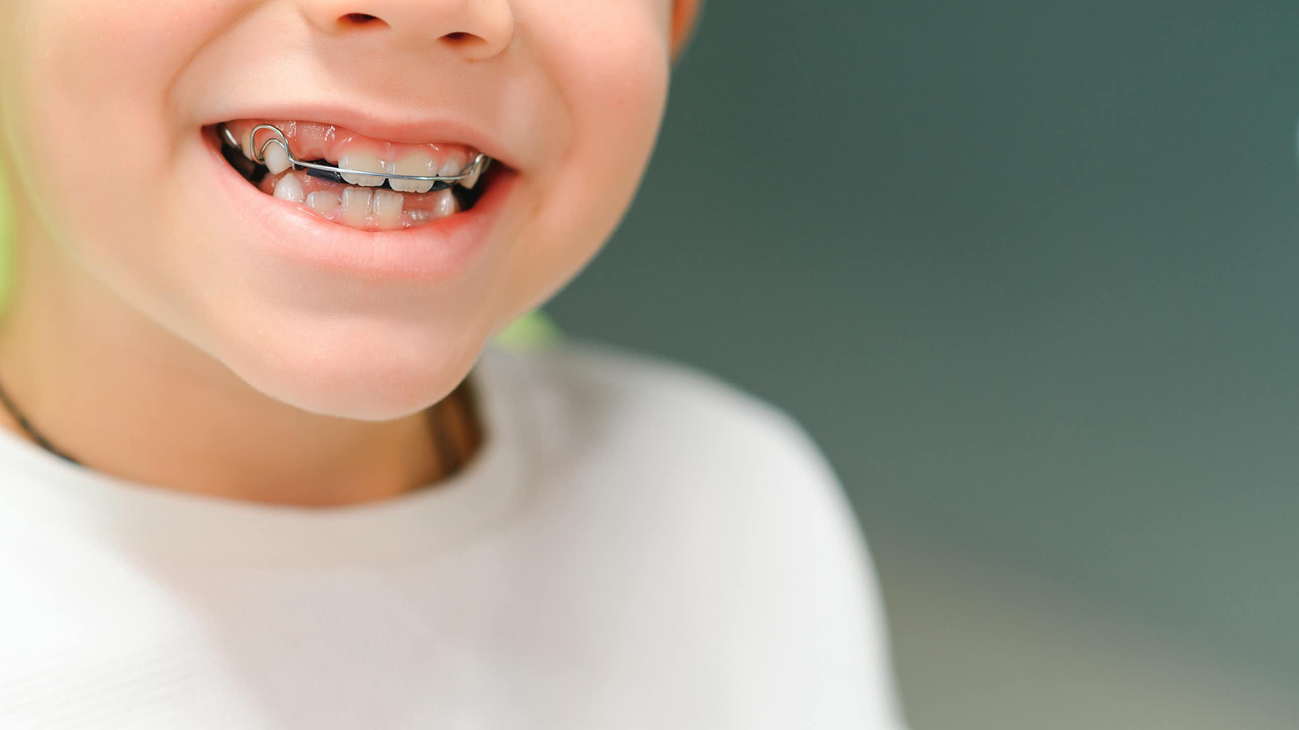 Un enfant avec un appareil dentaire