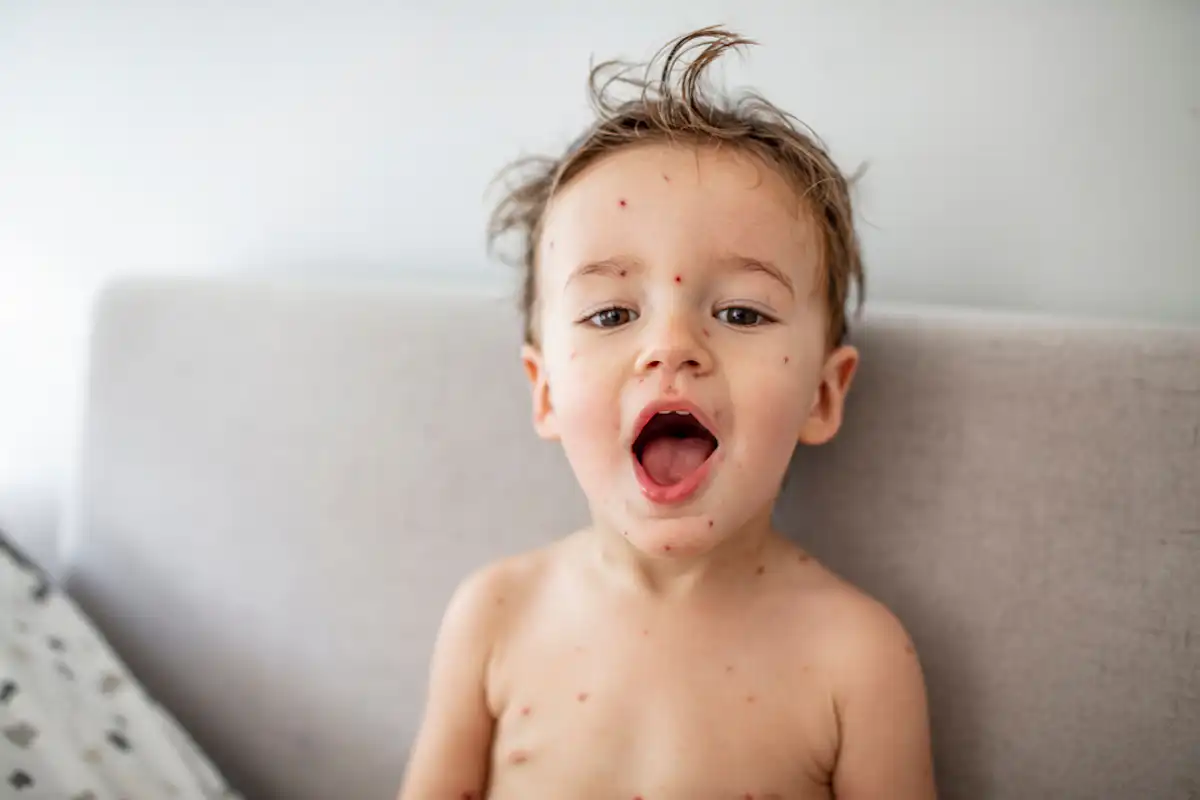 Checkpox MMRV: what families need to know about the UK’s new chickenpox vaccine