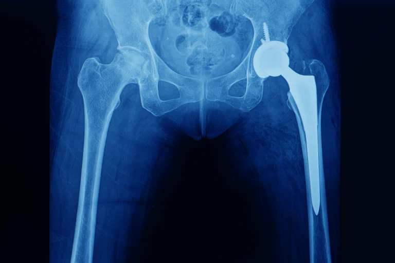 An x-ray of a person with a hip replacement to their left hip joint.