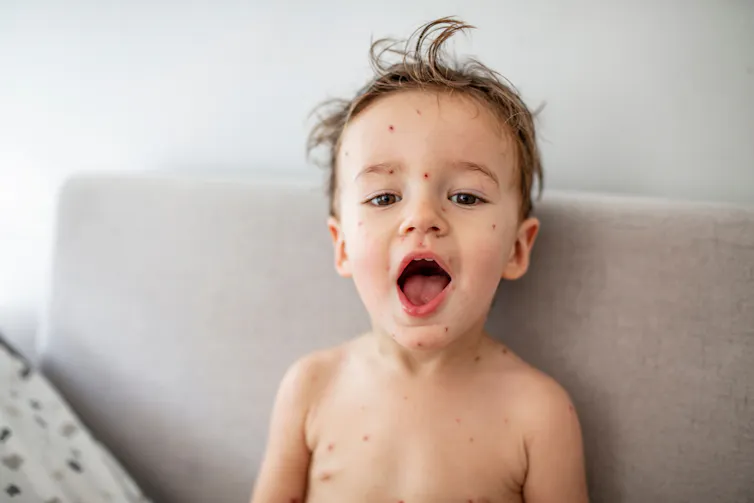 A child with chickenpox.