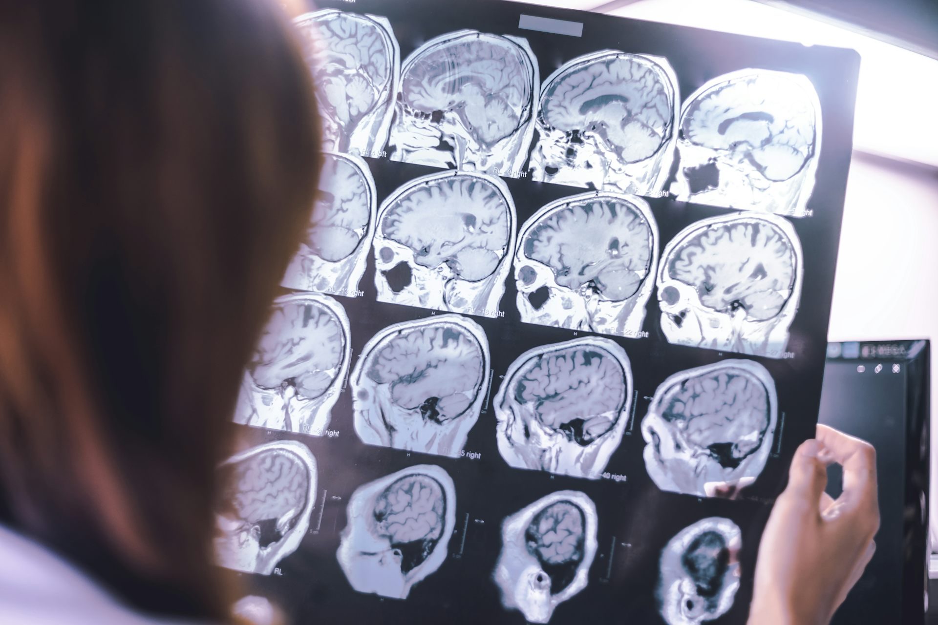 A doctor or nurse holds up a collection of MRI brain scans.