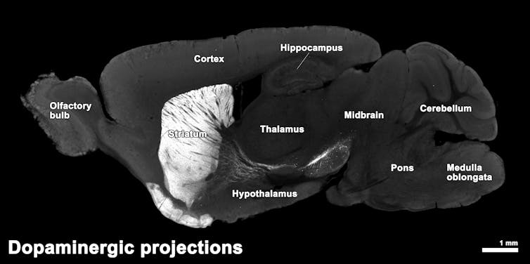 Image pinpointing the striatum in the brain.