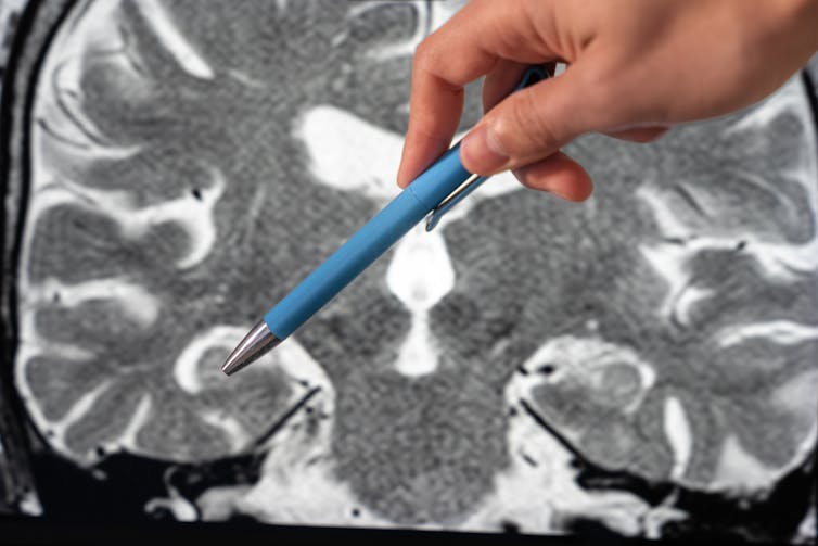 Hand with a blue pen points to the right hippocampus on a MRI scan