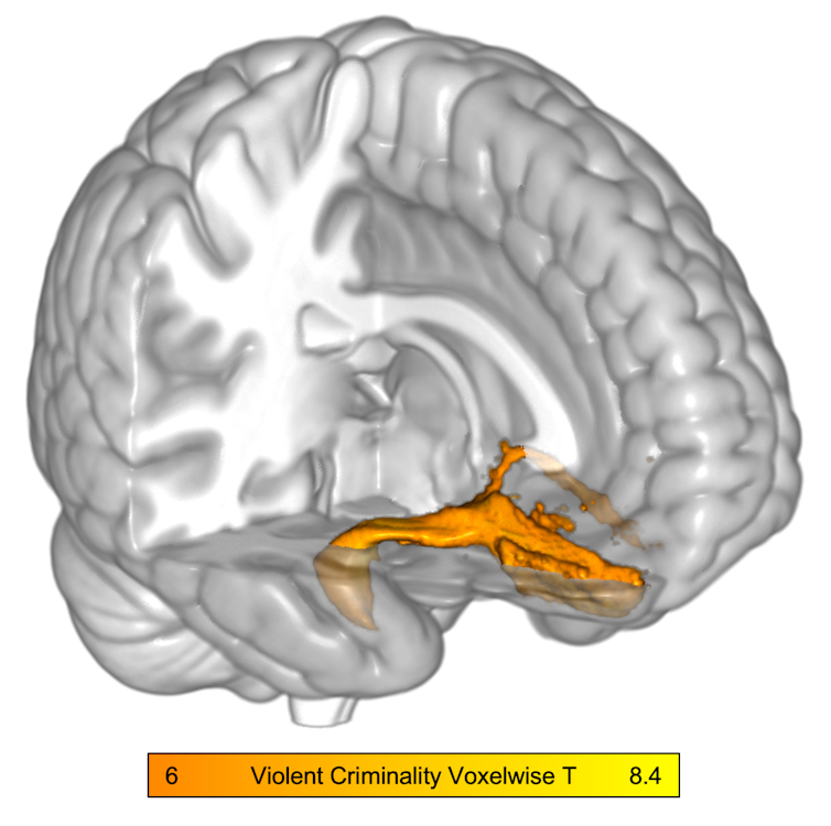 An MRI scan of the brain with the right uncinate fasciculus highlighted