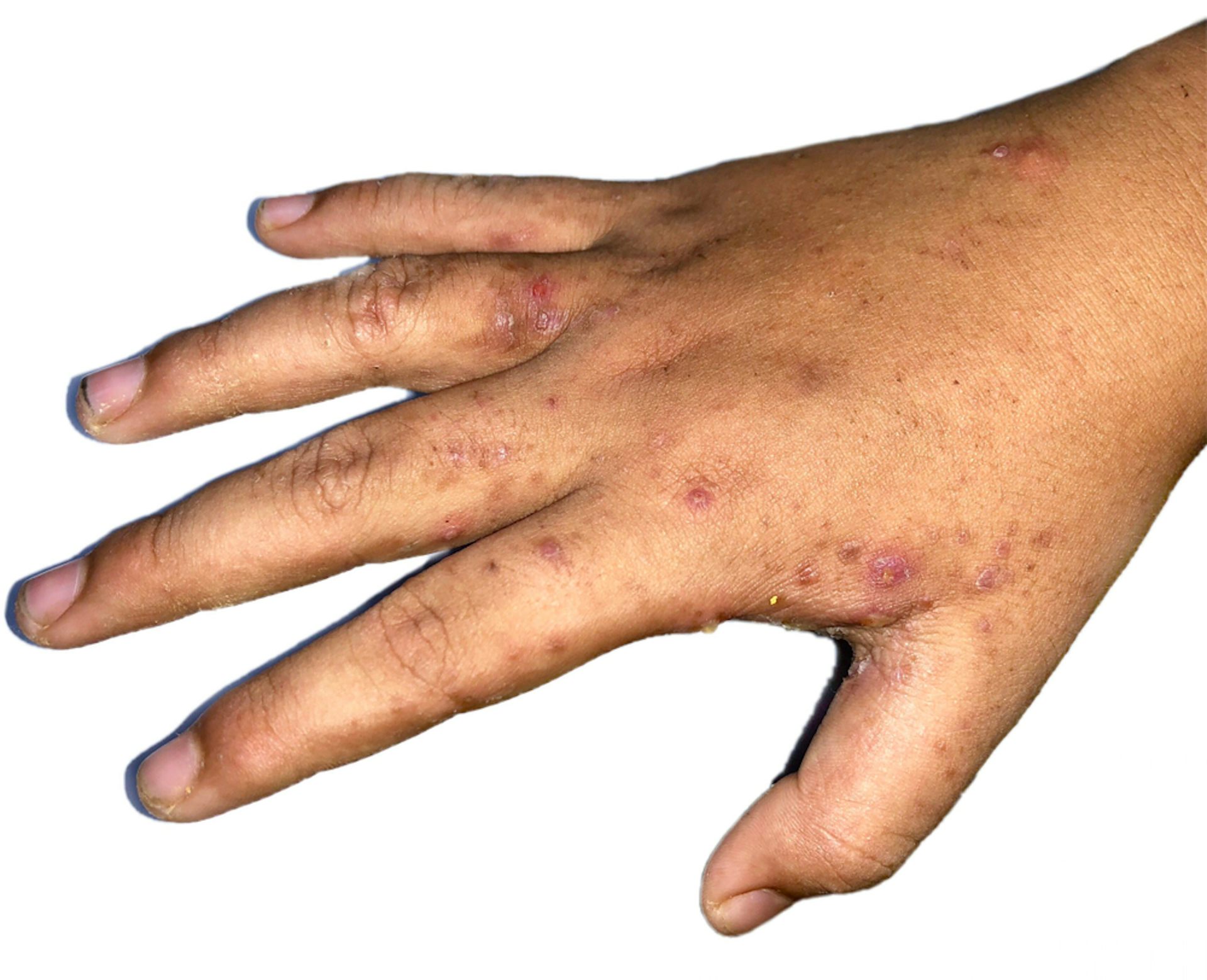 A hand with the telltale scabies rash.