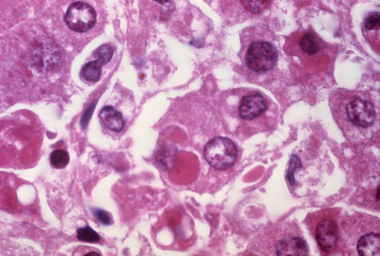 Pink and purple-stained light micrograph image of liver cells infected with Ebola virus.