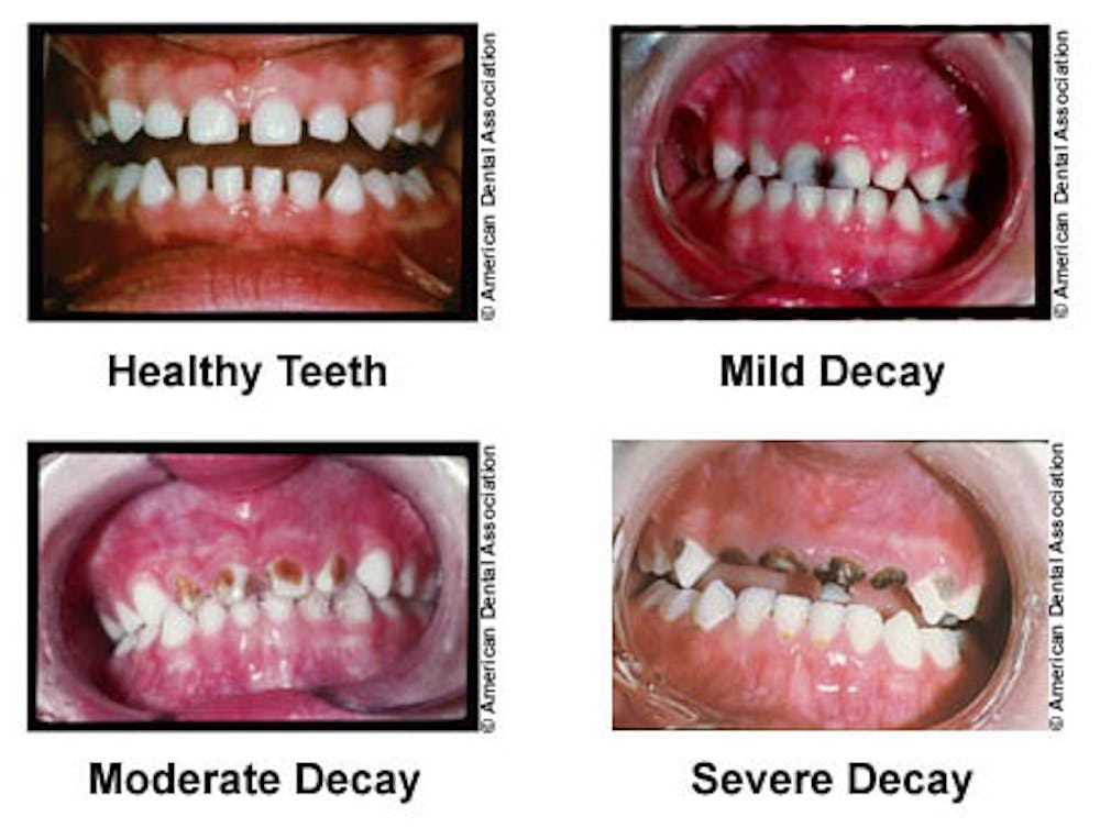 Studying Tooth Enamel Nanostructure May Lead To Less Time With The  Dentist's Drill