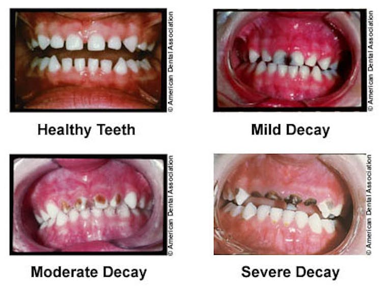 Studying Tooth Enamel Nanostructure May Lead To Less Time With The Dentist S Drill Studying Tooth Enamel Nanostructure May Lead To Less Time With The Dentist S Drill