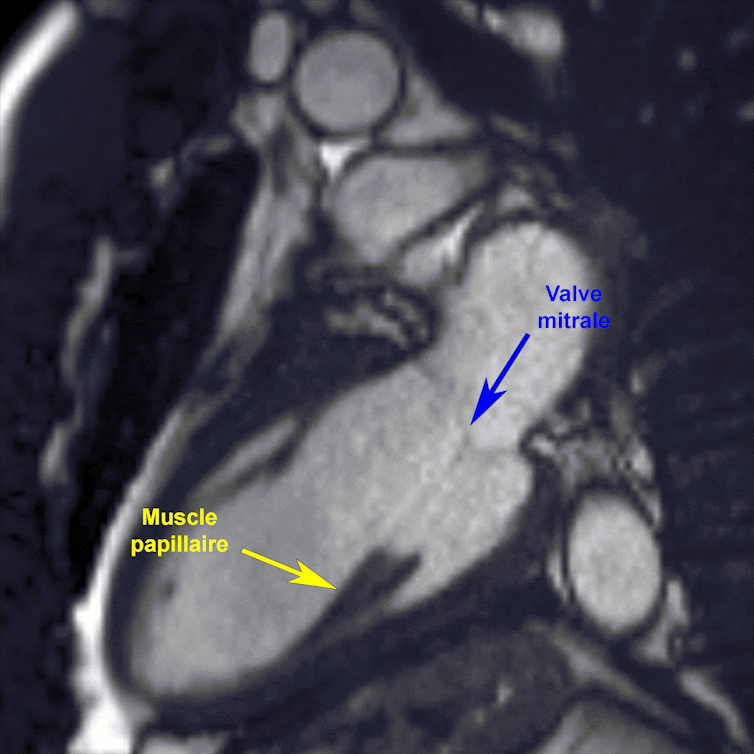Gif animé du cycle cardiaque du ventricule gauche ; le rythme cardiaque a été ralenti, afin d’avoir le temps d’apprécier la mécanique existant entre le muscle papillaire (indiqué par une flèche jaune) et la valve mitrale (flèche bleue).