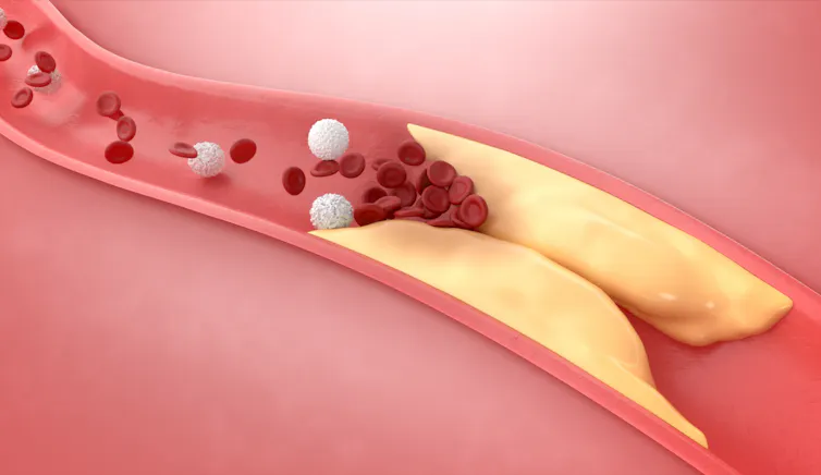 A digital drawing depicting cholesterol plaques on the artery wall, blocking blood flow.