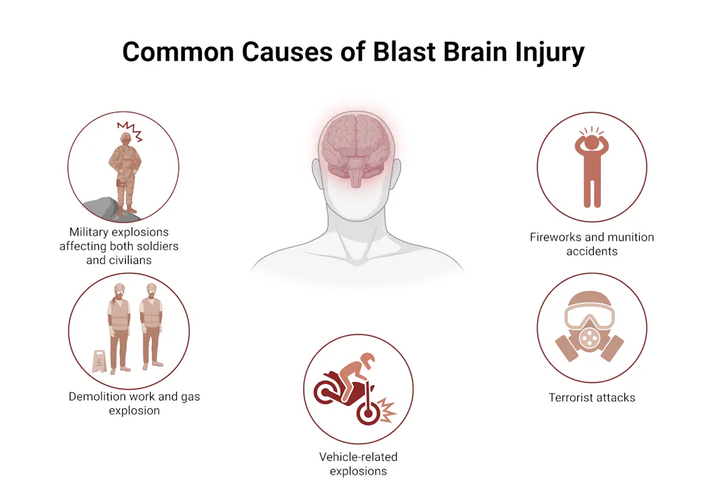 Blast Injuries Examples How blast waves can damage the brain without a head injury