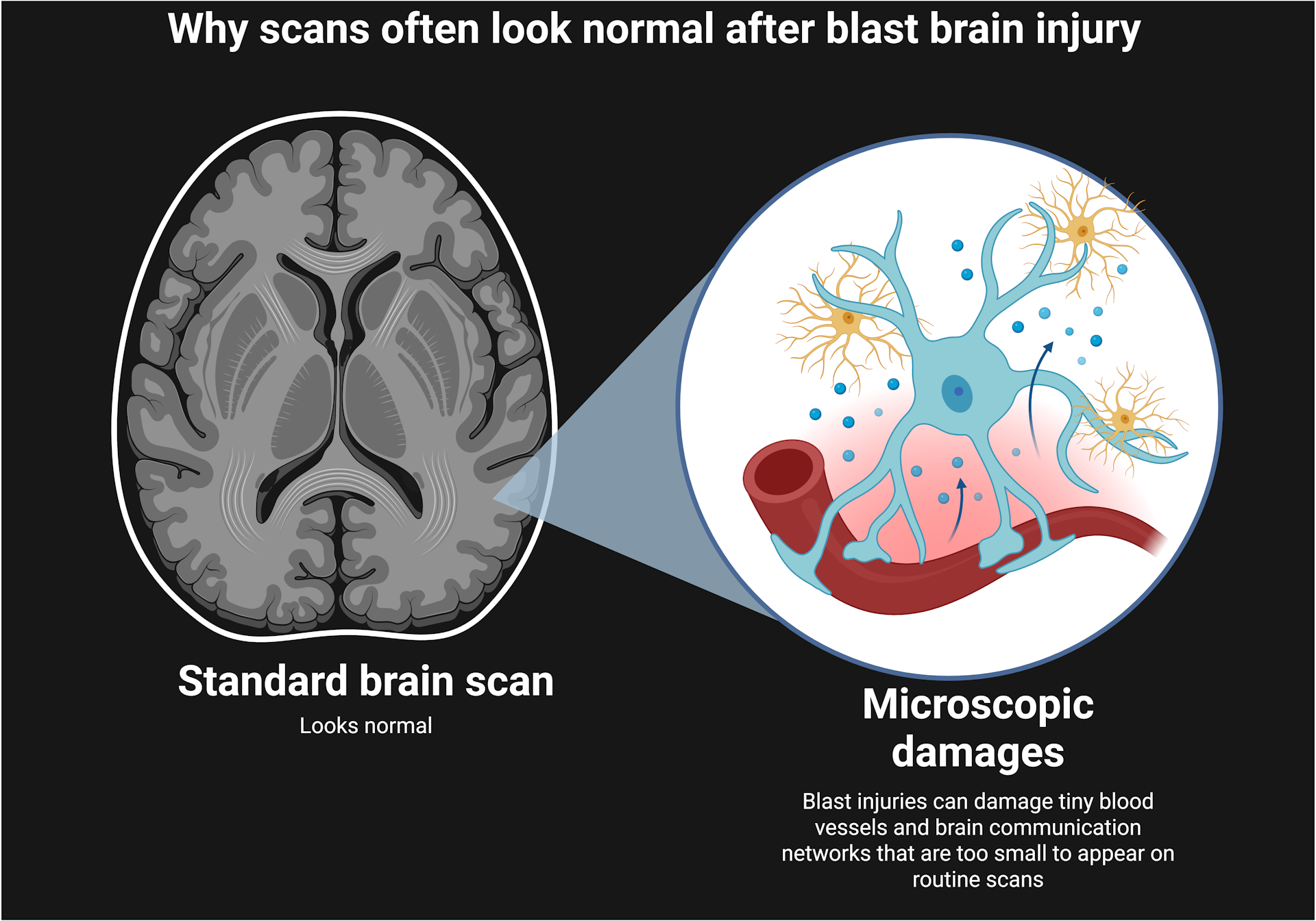 Diagram of why MRI scans often don't identify the microscopic damages of brain blast injuries