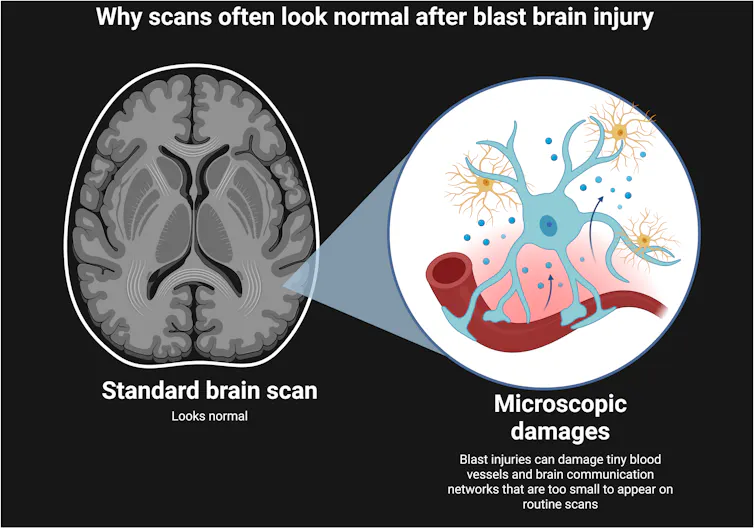 Diagram of why MRI scans often don't identify the microscopic damages of brain blast injuries