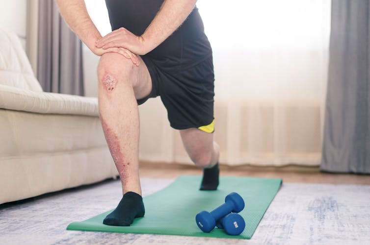 Man with psoriasis on leg does home exercises