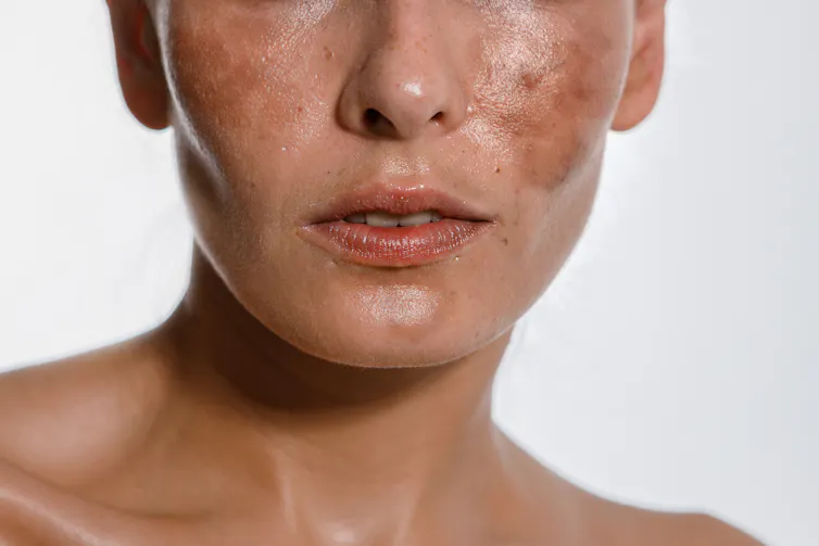 A woman's face showing areas of hyperpigmentation.