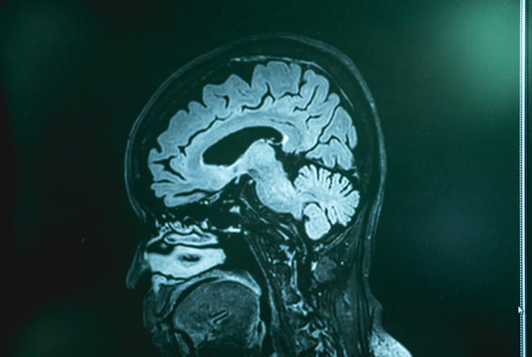 An MRI scan showing a brain with frontotemporal dementia.