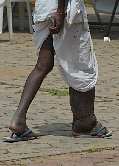 Close-up of a person's legs, one significantly swollen in comparison