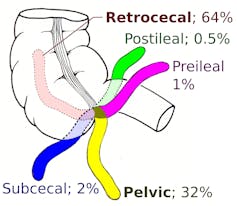 Diagram of a segment of the small intestine with fingers of the appendix oriented in various degrees