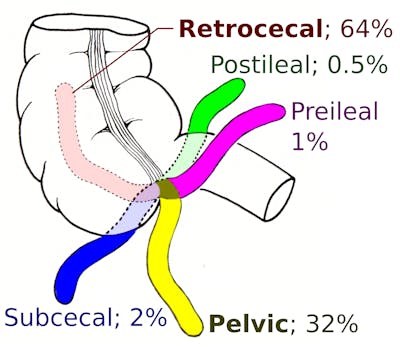 Diagram of a segment of the small intestine with fingers of the appendix oriented in various degrees