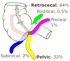 Diagram of a segment of the small intestine with fingers of the appendix oriented in various degrees