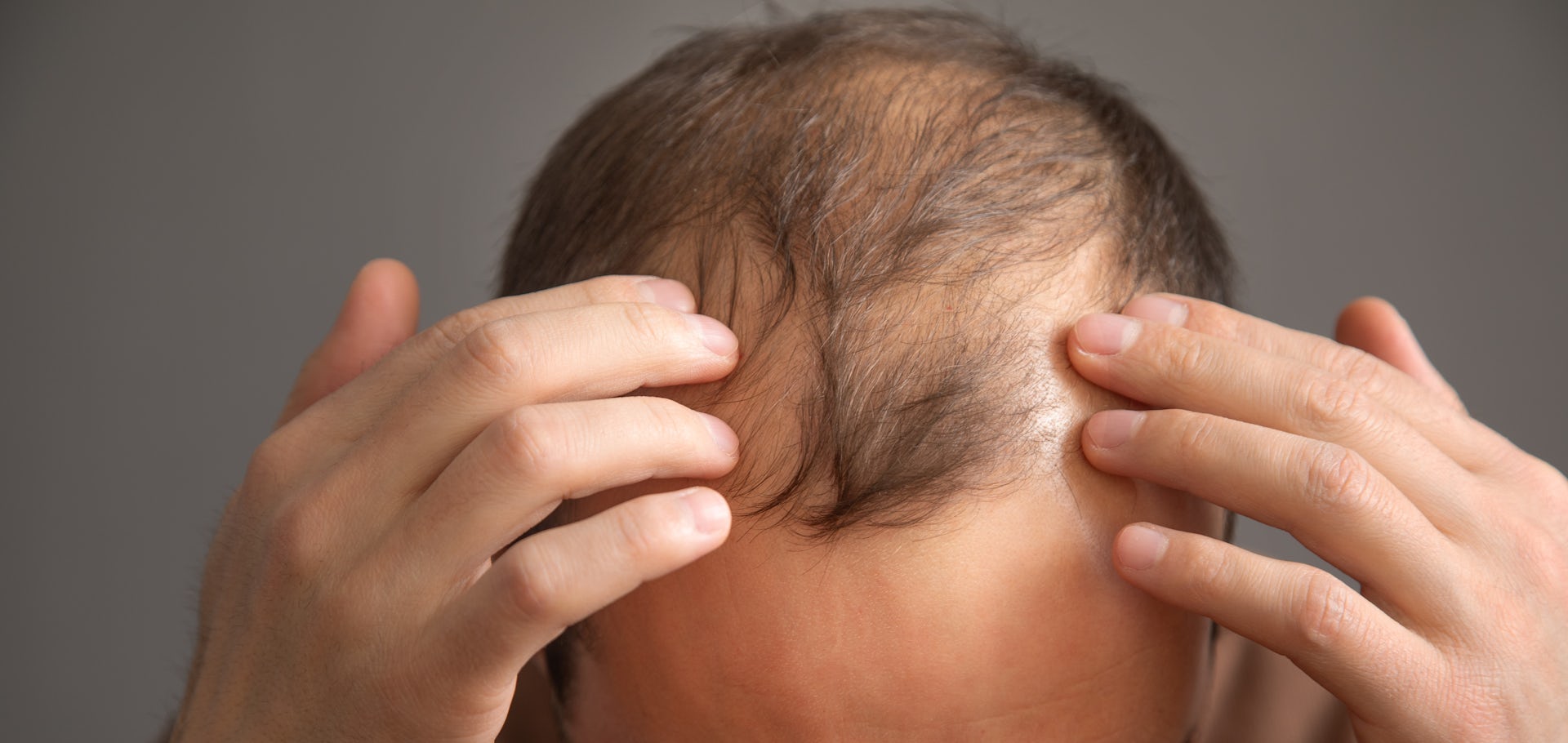 Un hombre señala las consecuencias de la alopecia en la cabeza
