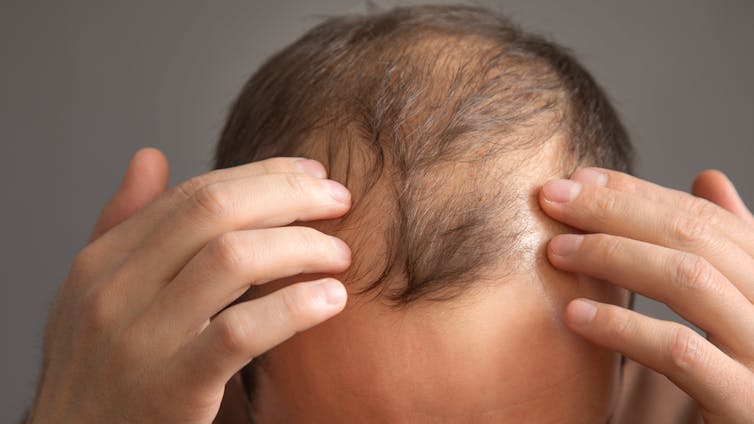 Un hombre seƱala las consecuencias de la alopecia en la cabeza