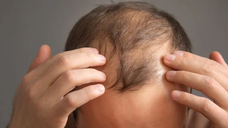 Un hombre señala los efectos de la alopecia en su cabeza