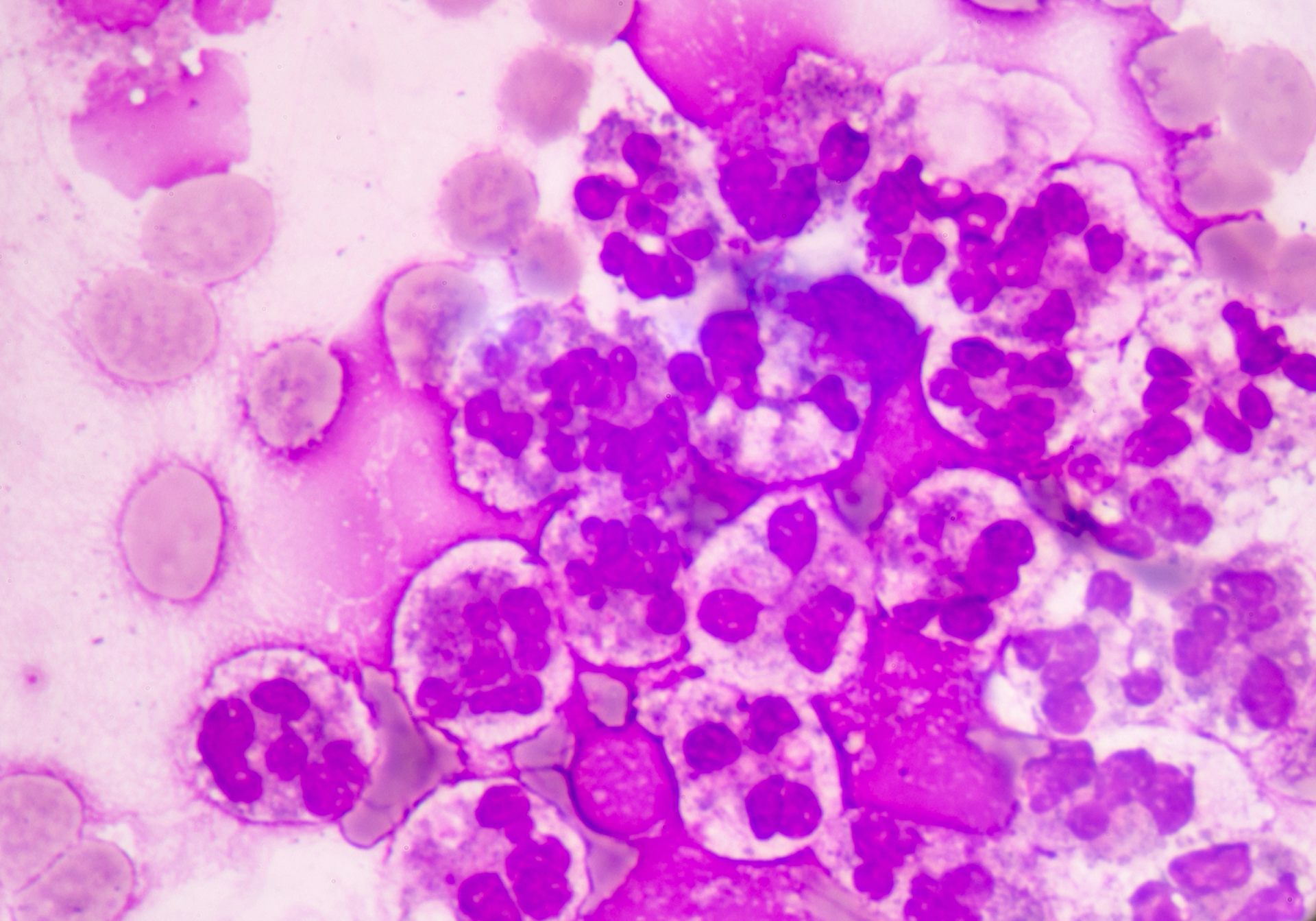 Why sepsis is becoming harder to treat in Europe