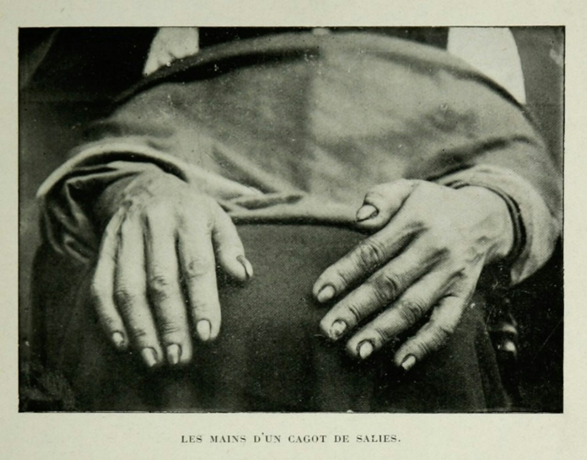 Carte postale présentant des « mains de cagots »