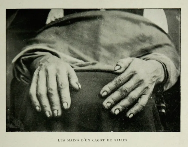 Carte postale présentant des « mains de cagots »