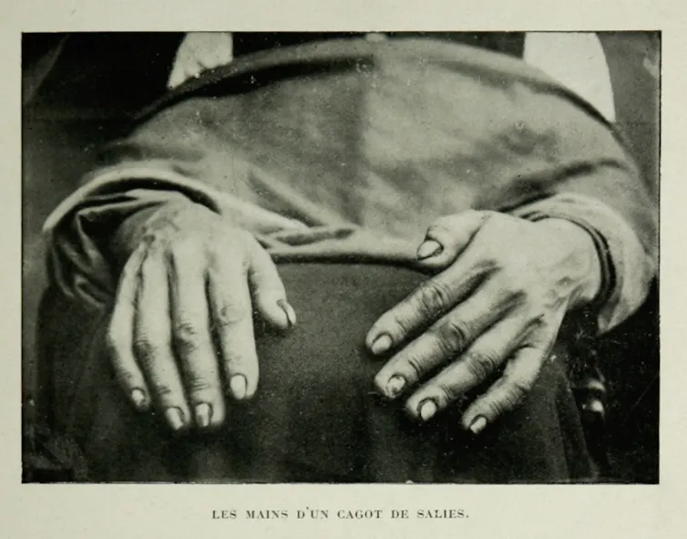 Carte postale présentant des « mains de cagots »
