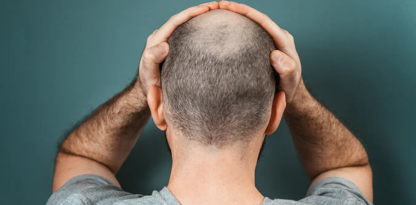 La terapia celular abre una nueva vía para acabar con la calvicie