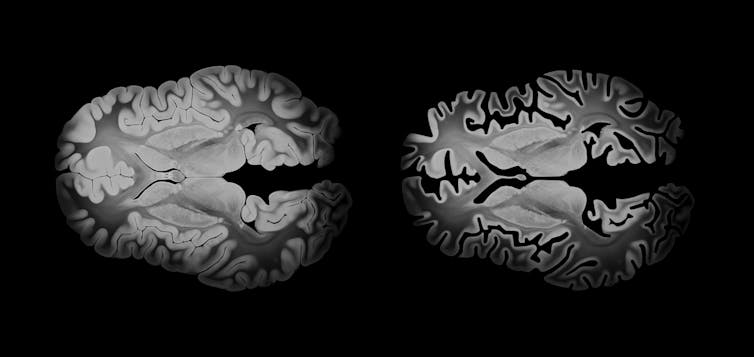 Alzheimer brain comparison in axial view showing differences between a healthy and affected brain, with cortical atrophy and neurodegeneration, displayed on a black background