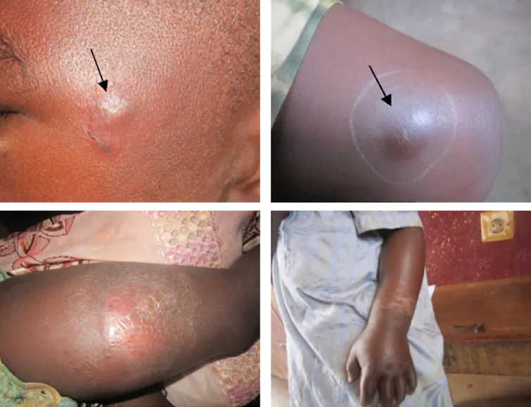 Flesh‑eating bacteria spread from possums and mozzies. But Buruli ulcers are preventable and treatable 1 Four images showing the early progression of Buruli ulcers