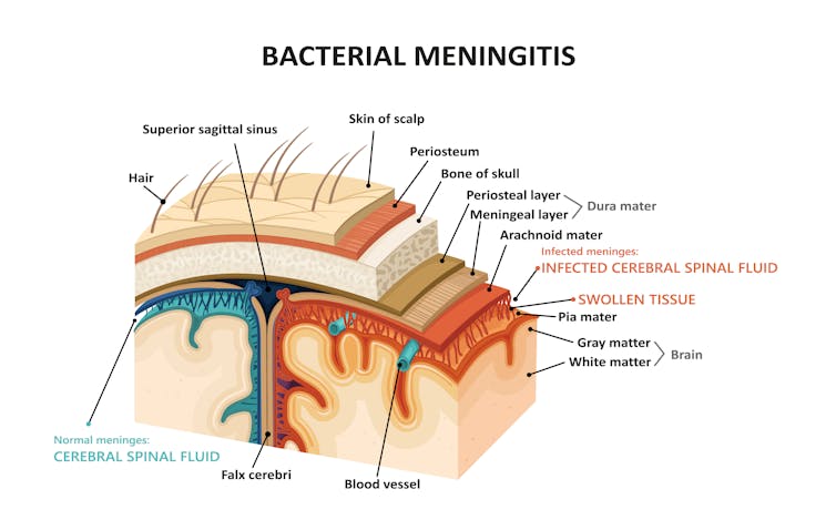 A graphic showing where the bacteria infect in bacterial meningitis.