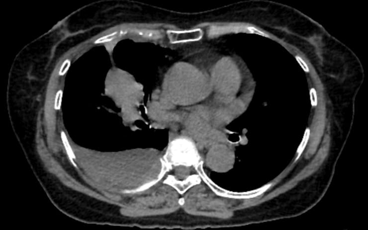 CT scan illustrating lung cancer.