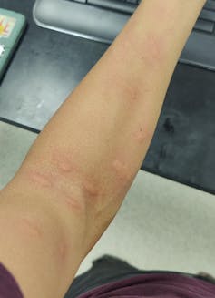 Man's arm with multiple pink raised welts