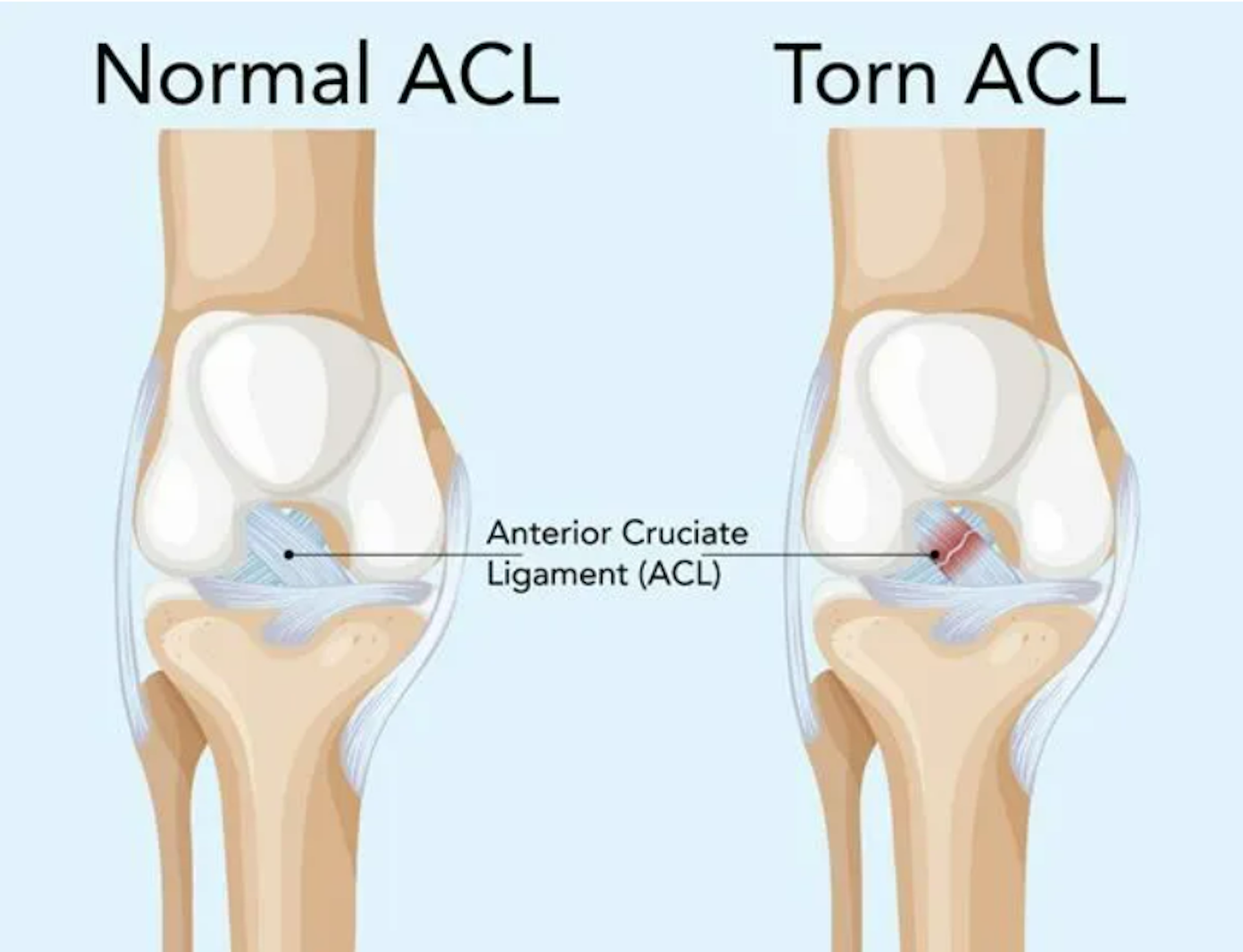 Injured your ACL? It&rsquo;s more than just a knee injury