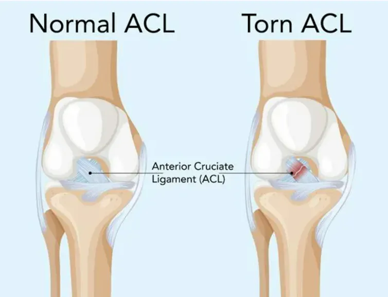 Detailed diagram of the ACL ligament, comparing a normal one on the left to a torn one on the right.