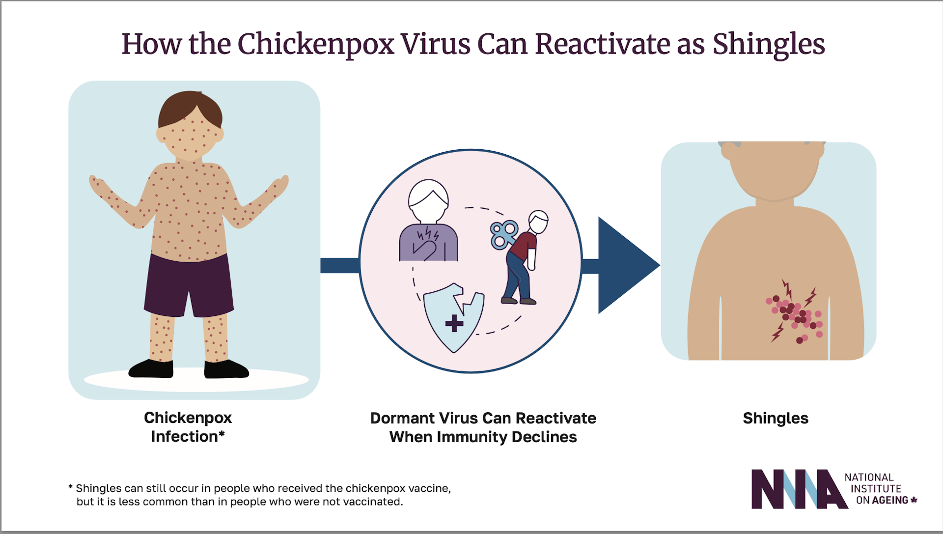 Ilustración de la reactivación del virus del herpes zóster